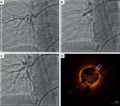 Long-Term Outcomes After Percutaneous Transluminal Pulmonary Angioplasty in Patients With Takayasu Arteritis and Pulmonary Hypertension